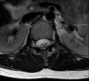 MRI T2 Lumbar Spine L1 Subpedicular Axial.jpg