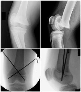 Figure 4: Salter-Harris I fracture of the distal femoral physis, treated with closed reduction and percutaneous pinning.