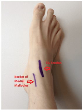 Medial approach: enter space between anterior border of the medial malleolus and the tibialis anterior tendon
