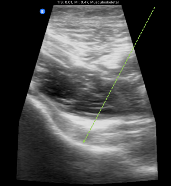 File:Hip Joint Injection Ultrasound.png