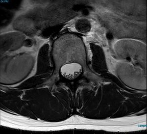 MRI T2 Lumbar Spine L2 Transpedicular Axial.jpg
