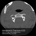 Hangman's fracture