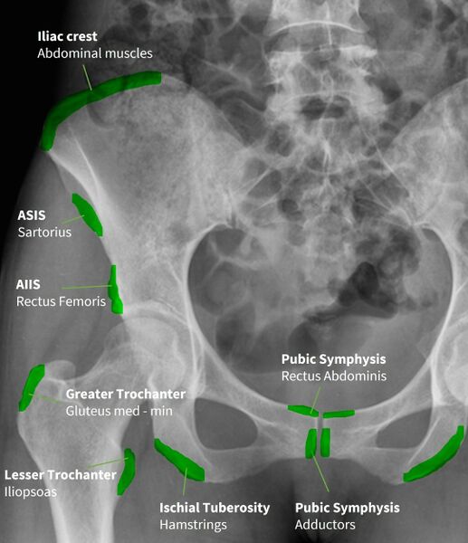 File:Pelvis and Hip Radiograph Muscle Attachments .jpg