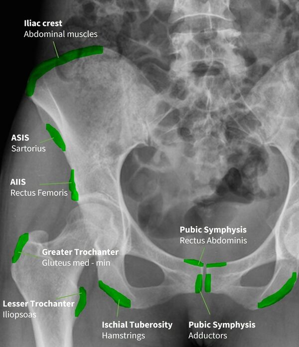 Apophysitis of the Pelvis and Hip - WikiMSK