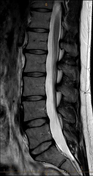 MRI T2 Lumbar Spine Sagittal Median.jpg