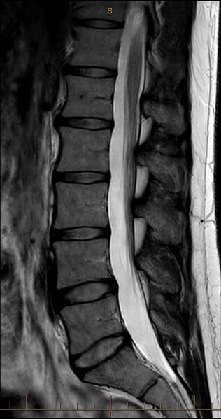 File:MRI T2 Lumbar Spine Sagittal Median.jpg