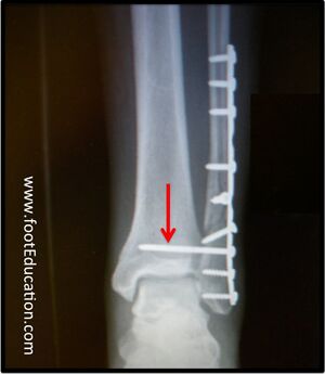 Ankle fracture fixation.jpg