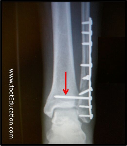 File:Ankle fracture fixation.jpg