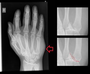 Figure 2: Fracture of the base of the 5th metacarpal. Soft tissue swelling, denoted by the arrow, is perhaps a more obvious finding than the fracture itself. To the right, a close-up view of the base of the metacarpal shows the fracture line, outlined in red in the image below.