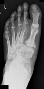 Charcot arthropathy affecting the tarsometatarsal joint AP.jpg