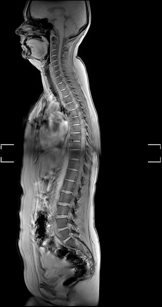 File:6 lumbar vertebrae on T2 sagittal entire spine.jpg