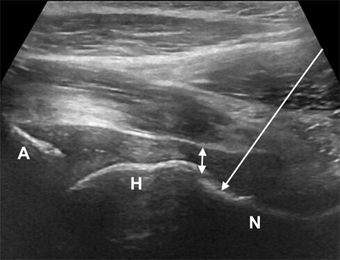 Anterior longitudinal approach. The needle is introduced from an inferior and anterior approach, lateral to the femoral neurovascular bundle (arrow). A, acetabulum; H, femoral head; N, femoral neck; double arrow – anterior joint recess.[2]