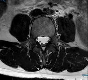 MRI T2 Lumbar Spine L4 Transpedicular Axial.jpg