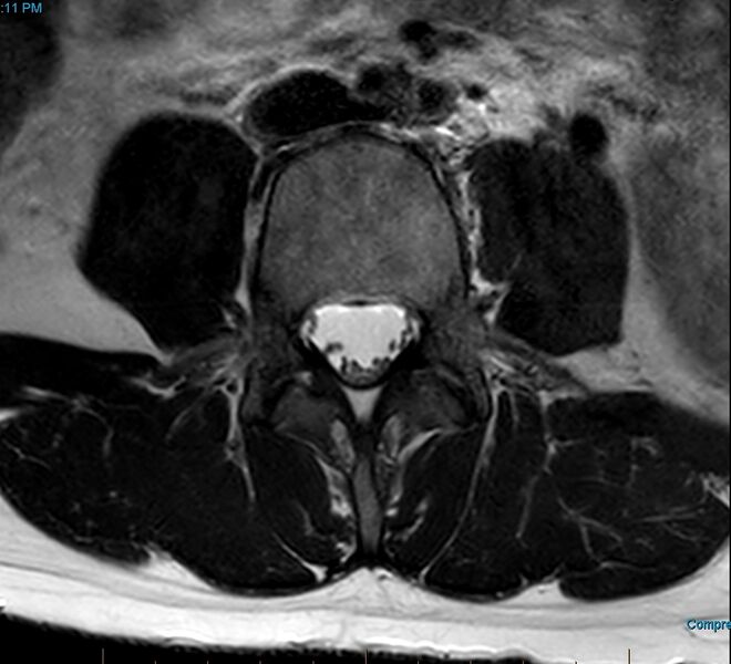 File:MRI T2 Lumbar Spine L4 Transpedicular Axial.jpg