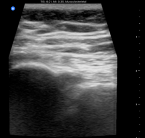 Sacroiliac joint left ultrasound.png
