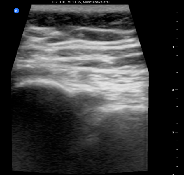 File:Sacroiliac joint left ultrasound.png