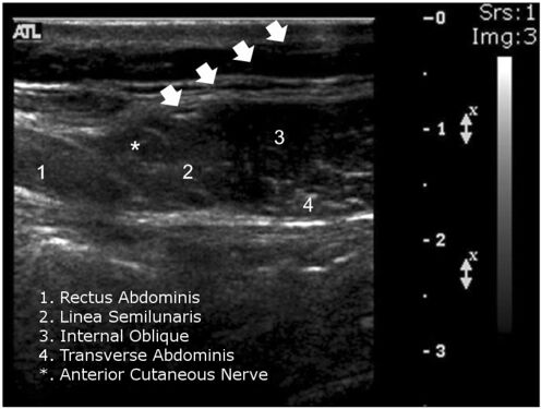 ACNES ultrasound2.jpg