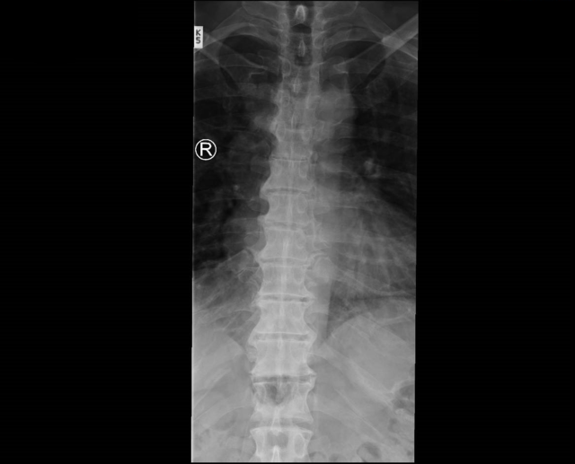 X Ray Dorso-lumbar Spine Lateral View shows bridging os