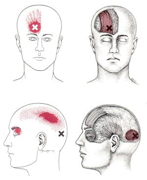 Occipitalis, Frontalis Trigger Points.jpg