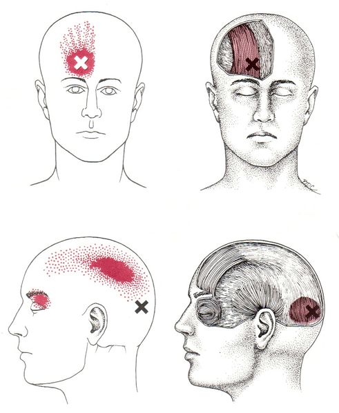 File:Occipitalis, Frontalis Trigger Points.jpg