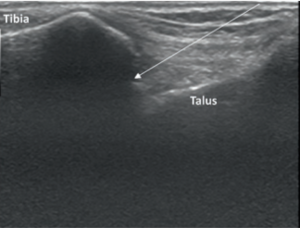 Tibiotalar joint injection ultrasound long axis2.png