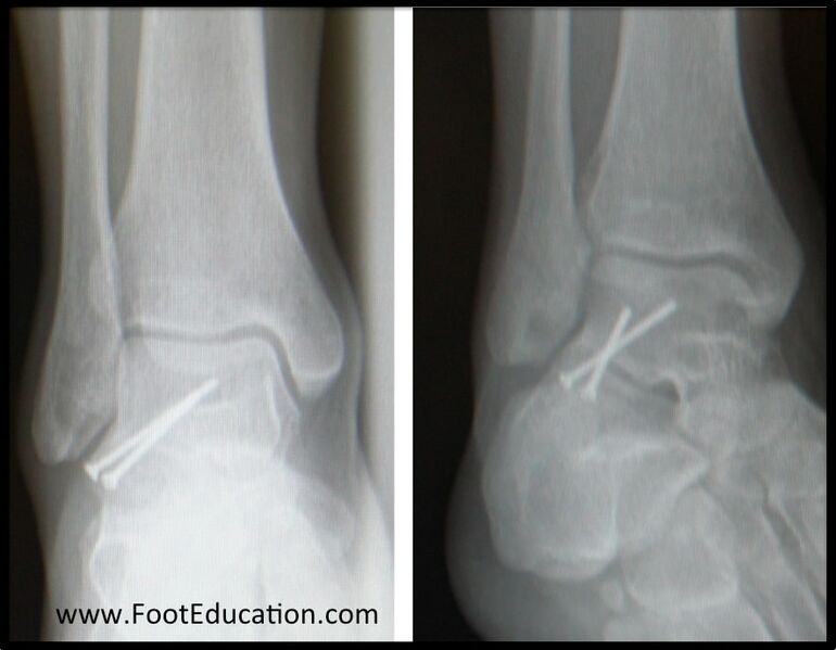 File:Lateral process fracture surgery.jpg