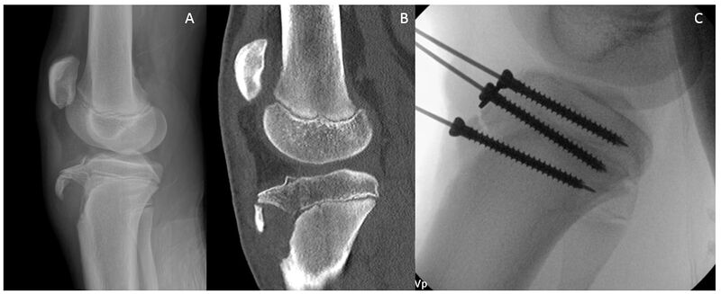 File:Displaced tibial tubercle fracture.jpg