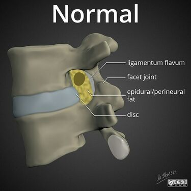 Normal: fat surrounds nerve root