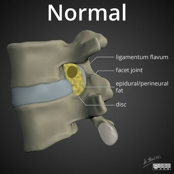 File:Lumbar-neuroforaminal-stenosis-normal.jpg