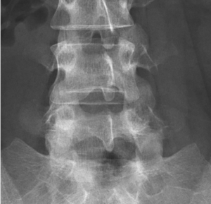 Lumbar Spine L4 and L5 AP Radiograph Normal.png