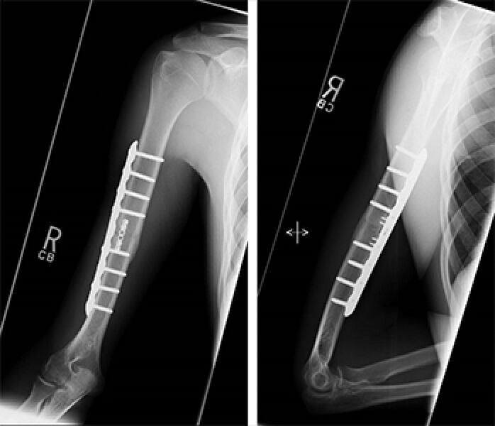File:Humerus fracture fixation.jpg
