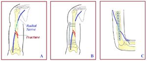 Humerus fracture radial nerve.jpg