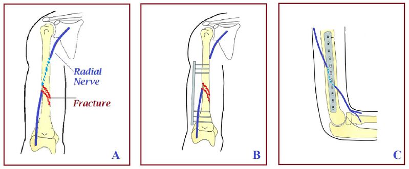 File:Humerus fracture radial nerve.jpg