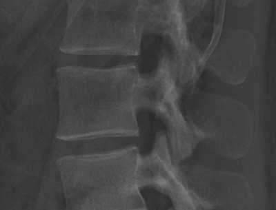 Lateral radiograph of L3