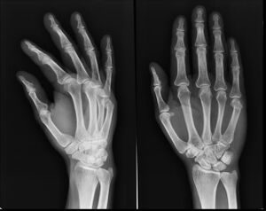 Figure 4: Boxer's fracture, i.e., a fracture of the neck of the 5th metacarpal. First metacarpal (thumb) fractures are uncommon. However, these fractures deserve special attention.