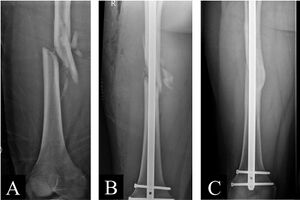 Figure 7: Preoperative (A), immediate postoperative (B), and 15-month postoperative (C) images of a 19-year-old man with a comminuted fracture of the right femur from a motorcycle accident. (Images courtesy of Role of open cerclage wiring in patients with comminuted fractures of the femoral shaft treated with intramedullary nails. J Orthop Surg Res 16, 480 (2021))