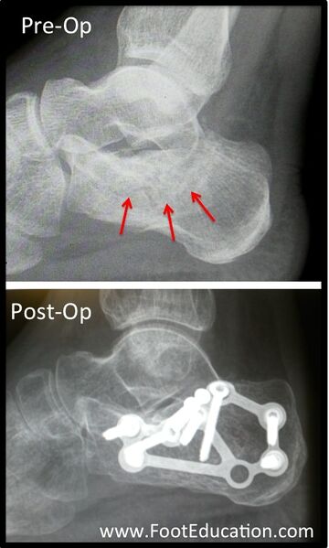 File:Depressed calcaneal fracture pre and post op.jpg