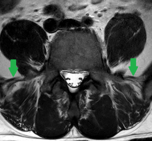 Iliolumbar ligament on MRI.PNG