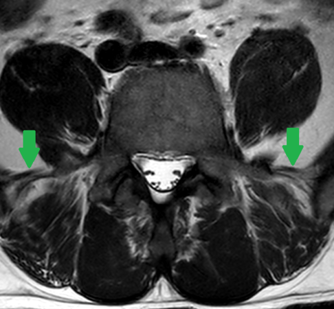 The Iliolumbar ligaments seen on an axial T2 weighted MRI sequence extending from the transverse process of L5 to the posteromedial iliac crest.