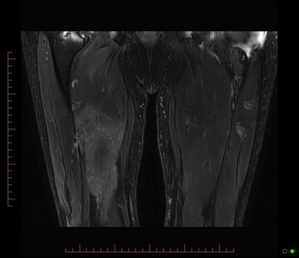 MRI myositis T2 increased muscle signal.jpg