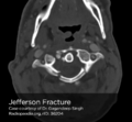 Jefferson fracture