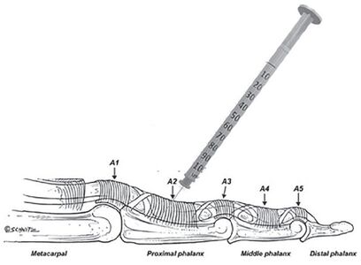 The digital pulley system and flexor tendon sheath injection at the proximal phalanx.