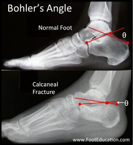Figure 8: Normal (Top) and Abnormal (Bottom) Bohler’s Angle on Lateral Foot X-Ray.