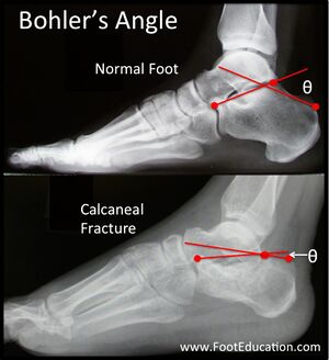 Bohlers angle foot normal and abnormal.jpg
