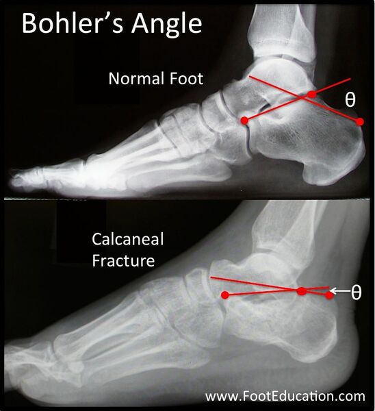 File:Bohlers angle foot normal and abnormal.jpg