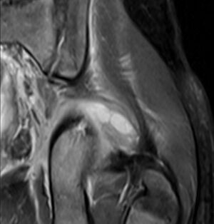 Cor T2 MRI tropical pyomyositis.jpg
