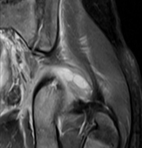 File:Cor T2 MRI tropical pyomyositis.jpg