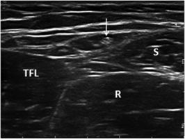 Transverse ultrasound image of the LFCN lying within the intermuscular space between the tensor fasciae latae muscle and the sartorius. LFCN: lateral femoral cutaneous nerve; TFL: tensor fasciae latae muscle; S: Sartorius; R: rectus femoris.[2]
