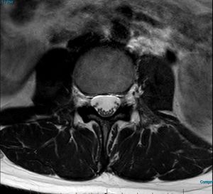 MRI T2 Lumbar Spine L3 Subpedicular Axial.jpg