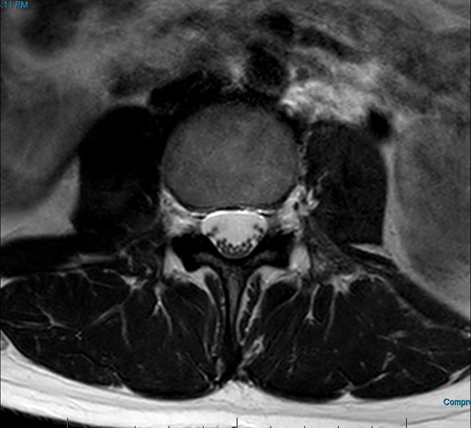 File:MRI T2 Lumbar Spine L3 Subpedicular Axial.jpg
